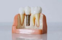 种牙和镶牙哪个好？区别在哪里?分享两种手术的区别来了